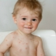 Varicella-zoster virüsü ve herpes virüsü ve enterovirüs enfeksiyonu farklılıkları