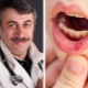 Si Dr. Komarovsky tungkol sa stomatitis