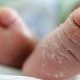 ماذا تفعل إذا جلد التقشير؟