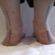 Rawatan untuk kaki rata-valgus pada kanak-kanak