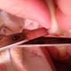 Pagputol, pagbabalot o pag-clamping ng umbilical cord matapos ang paghahatid
