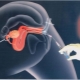 Was ist eine intrauterine Insemination und wie wird das Verfahren durchgeführt?