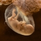 Schwangerschaft nach IVF: Ursachen und Auswirkungen