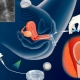 Warum ist die Implantation des Embryos nicht immer nach der IVF? Ursachen und Symptome