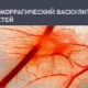 Hemorrhagic vasculitis sa mga bata: mula sa mga sintomas hanggang sa paggamot