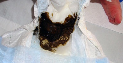 Meconium siyah ve yeşil