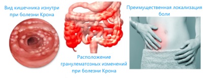 Болест на Крон