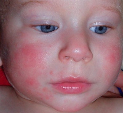 Allergische Dermatitis bei einem Kind