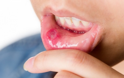Stomatitis sa isang bata