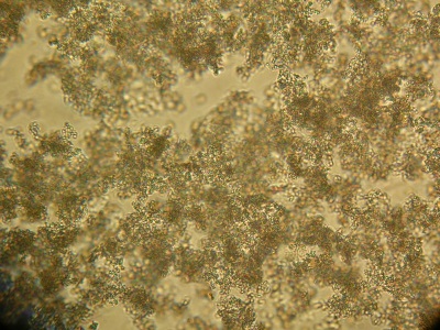 Amorphe Phosphate im Urin