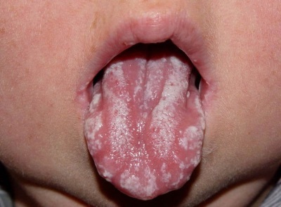 Stomatitis sa mga sanggol