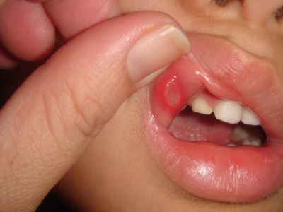 Aphthous stomatitis sa isang bata