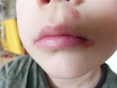 herpes em uma criança