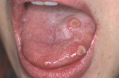 Stomatitis sa dila